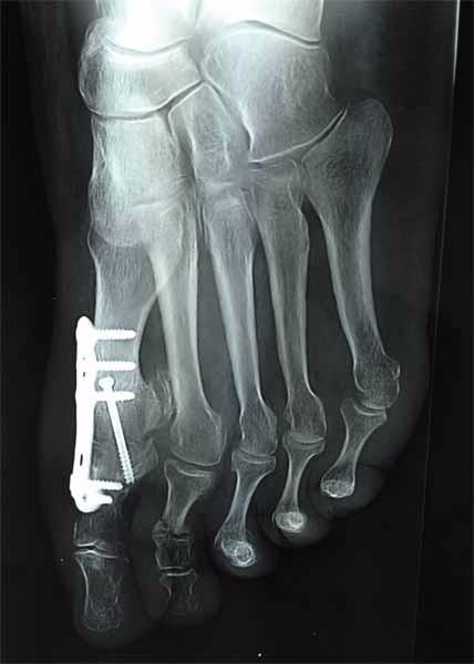 traitement hallux rigidus