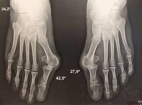 hallux rigidus