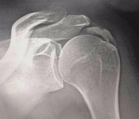 calcification des tendons